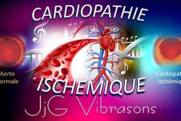 CARDIOPATHIE ISCHÉMIQUE CARDIOPATHIE ISCHÉMIQUE